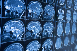How the Law Office of Michael J. Tremoulis Can Help You After a Brain Injury In Lima, OH